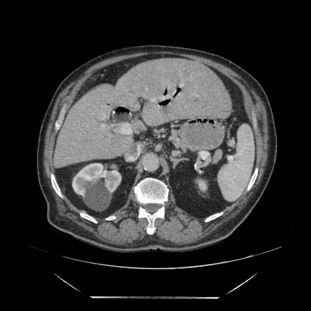 Cholecystoduodenal fistula | Image | Radiopaedia.org