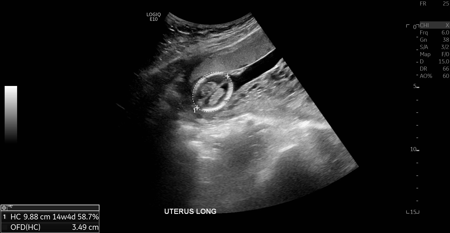 Molar pregnancy with coexisting live intrauterine pregnancy | Image ...