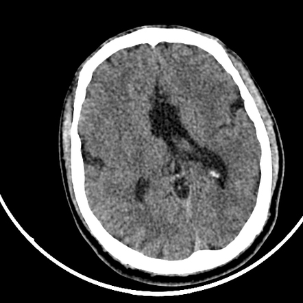 Open lip schizencephaly | Radiology Case | Radiopaedia.org