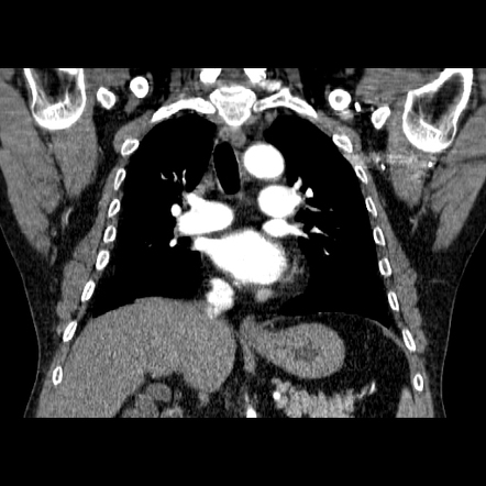 Acute pulmonary embolism | Image | Radiopaedia.org