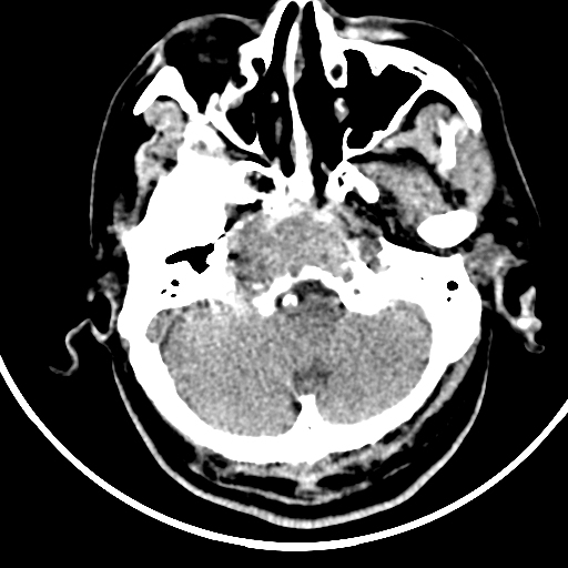 Chordoma | Image | Radiopaedia.org