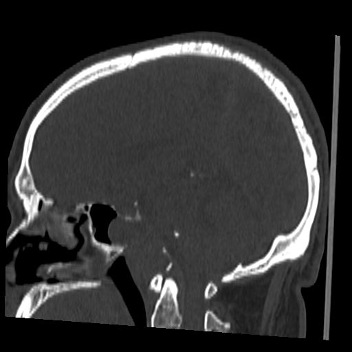 Chordoma | Image | Radiopaedia.org