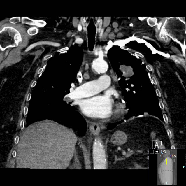 Lung Cancer Due To Asbestos Exposure | Image | Radiopaedia.org