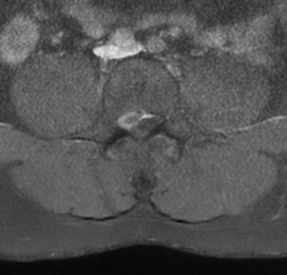 Disc sequestration | Image | Radiopaedia.org