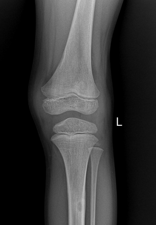 Fibrous cortical defect | Radiology Case | Radiopaedia.org