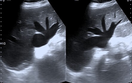 Congestive Cardiac Failure Abdominal Ultrasound Radiology Case