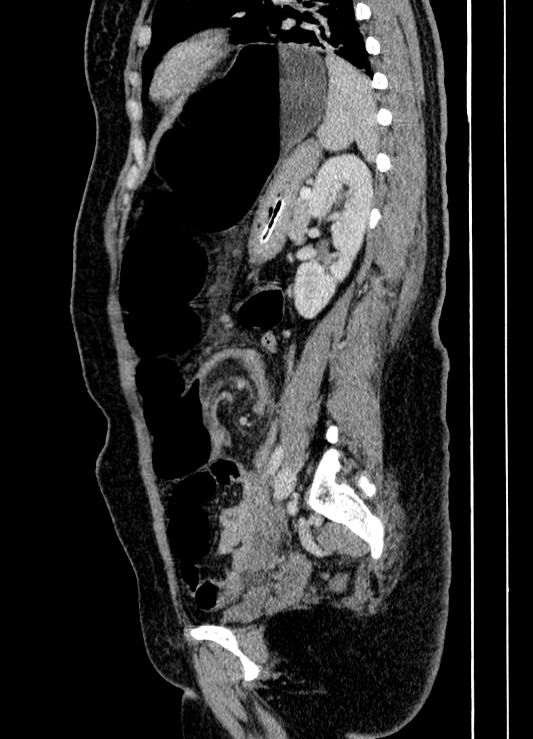 Sigmoid volvulus | Image | Radiopaedia.org