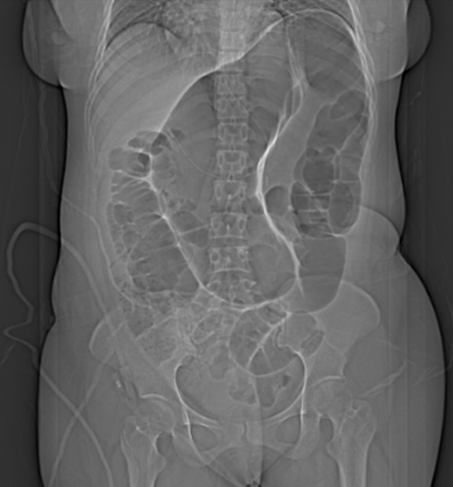 Sigmoid volvulus | Radiology Case | Radiopaedia.org