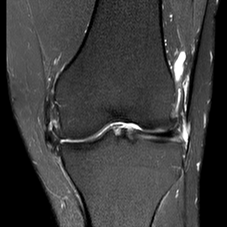 Post traumatic osteoarthritis following chronic ACL tear | Radiology ...