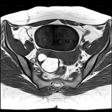 Ovarian endometriomas | Image | Radiopaedia.org