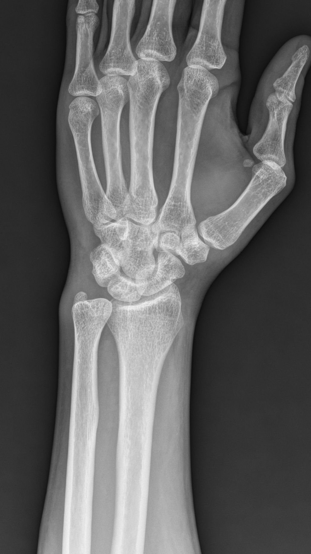 Ulnar Impaction Syndrome Image