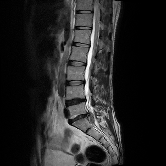 Lumbar disc extrusion/sequestration | Image | Radiopaedia.org