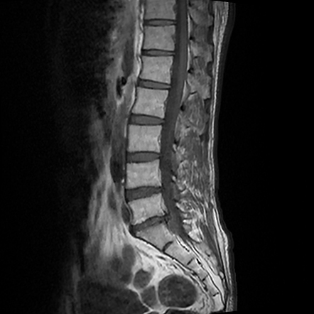 Lumbar disc extrusion/sequestration | Image | Radiopaedia.org