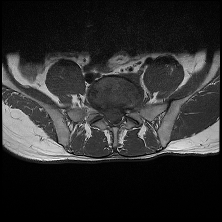 Lumbar Disc Extrusion Sequestration 