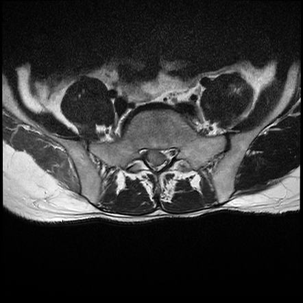 Lumbar disc extrusion/sequestration | Image | Radiopaedia.org