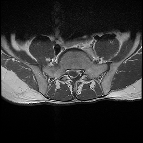 Lumbar disc extrusion/sequestration | Image | Radiopaedia.org