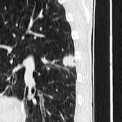 Lung Cancer | Radiology Reference Article | Radiopaedia.org