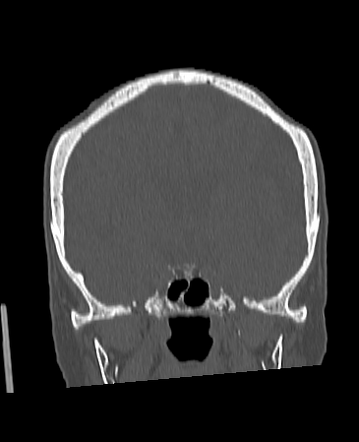 Biparietal Osteodystrophy | Radiology Case | Radiopaedia.org