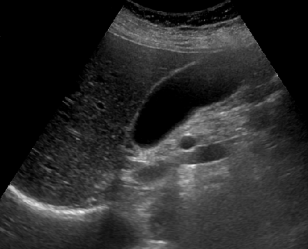 Normal ejection fraction of the gallbladder | Image | Radiopaedia.org