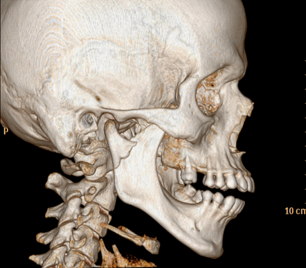 Mandible fracture | Radiology Case | Radiopaedia.org