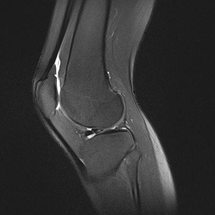 bucket handle lateral meniscus tear icd 10