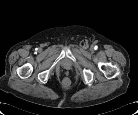 Femoral hernia | Radiology Reference Article | Radiopaedia.org