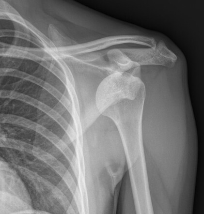 Anterior shoulder dislocation | Radiology Case | Radiopaedia.org