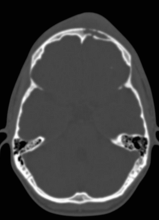 Pott Puffy Tumor | Image | Radiopaedia.org