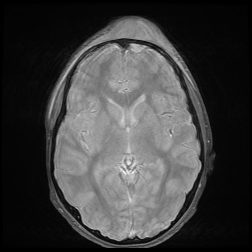 Pott Puffy Tumor Image