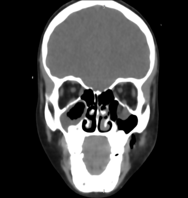 Orbital trapdoor fracture | Image | Radiopaedia.org