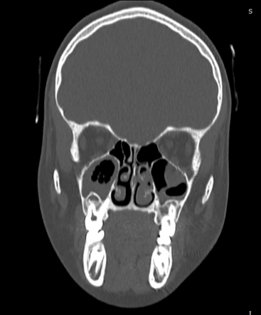 Orbital trapdoor fracture | Image | Radiopaedia.org