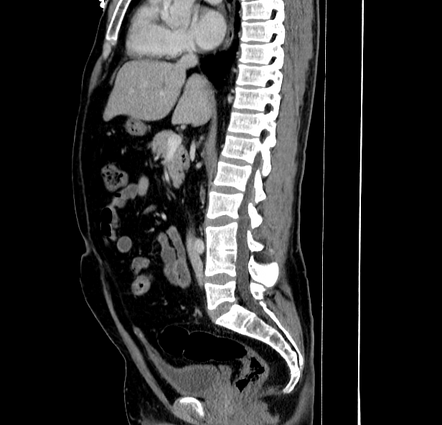 Vesicourachal diverticulum | Radiology Case | Radiopaedia.org