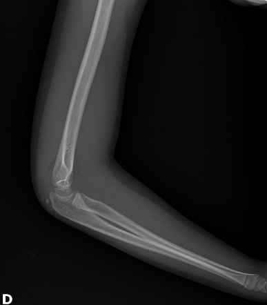 Supracondylar fracture - Gartland type I | Image | Radiopaedia.org