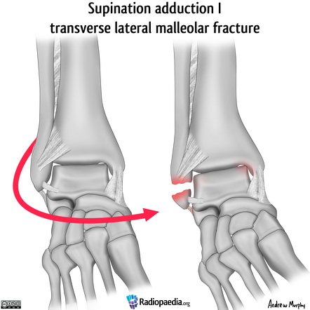 Lauge-Hansen classification of ankle fractures (illustrations) | Image ...