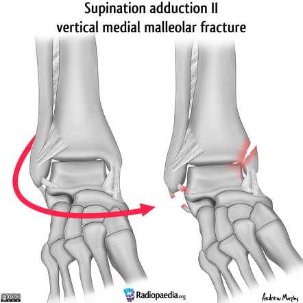 Lauge-Hansen classification of ankle fractures (illustrations) | Image ...