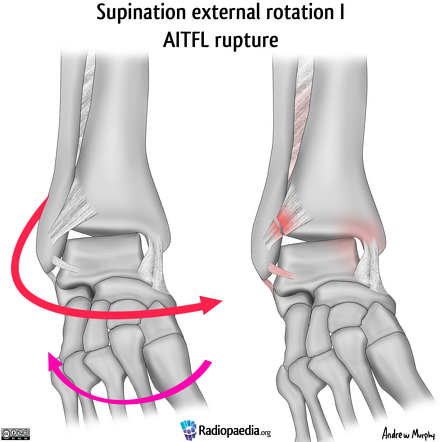 Ankle fracture 2025 lauge hansen classification