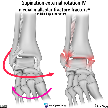 Lauge-Hansen classification of ankle fractures (illustrations) | Image ...