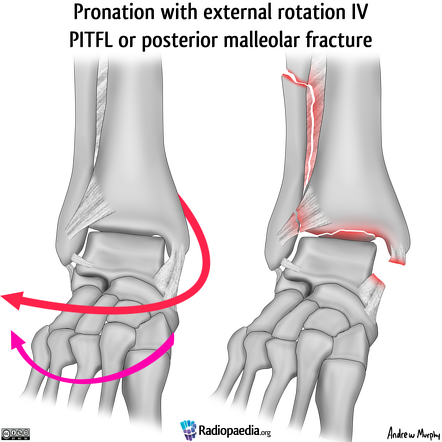 Lauge-Hansen Classification Of Ankle Fractures (illustrations) | Image ...