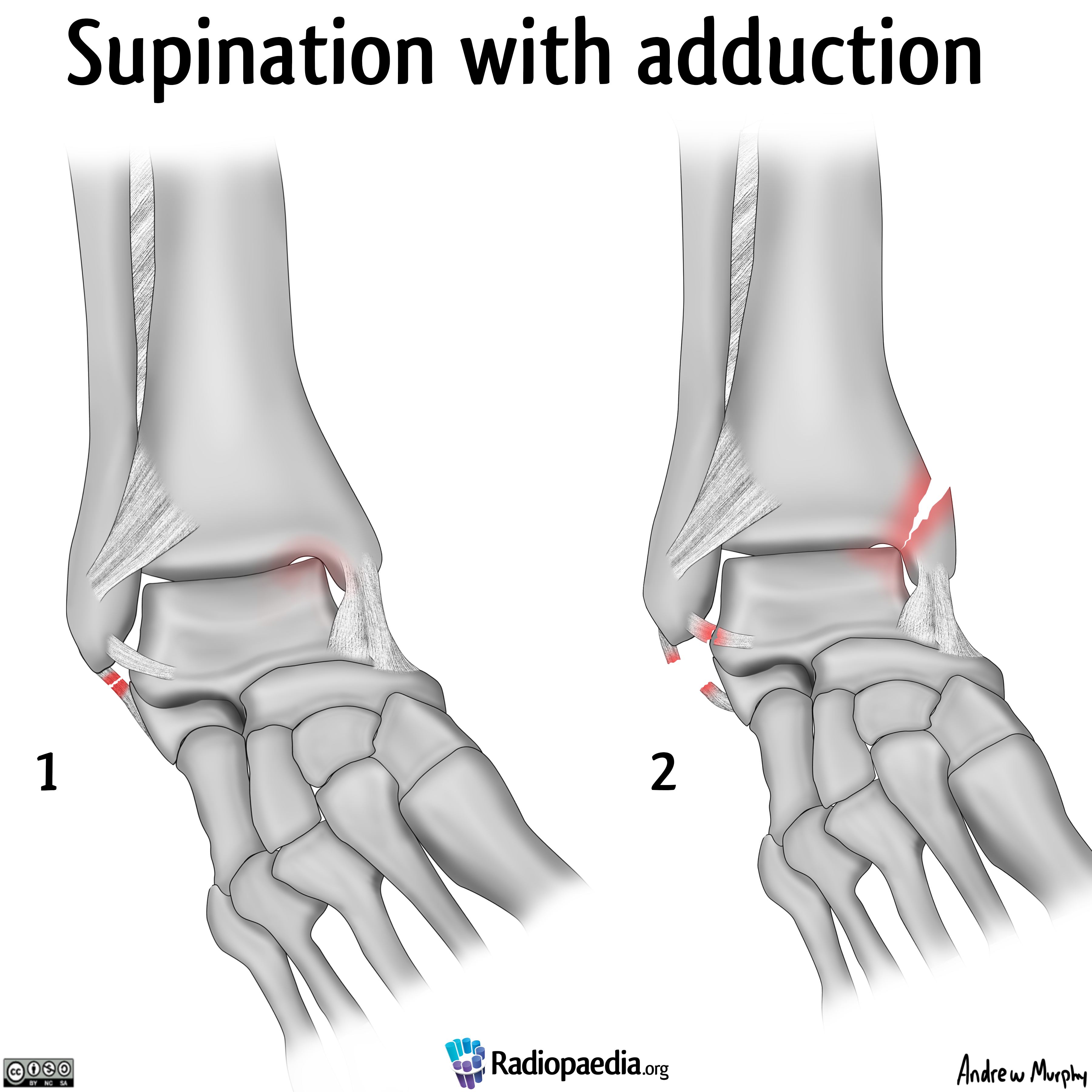 Image | Radiopaedia.org