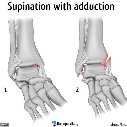 Ankle supination trauma