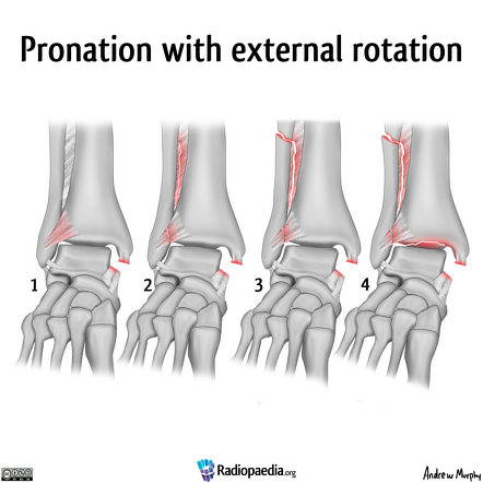 Lauge-Hansen classification of ankle injury | Radiology Reference ...