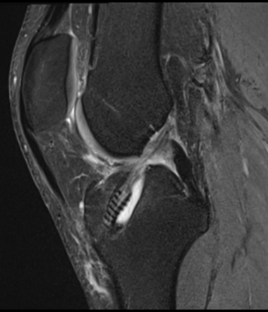 Communicating tibial tunnel cyst | Radiology Case | Radiopaedia.org