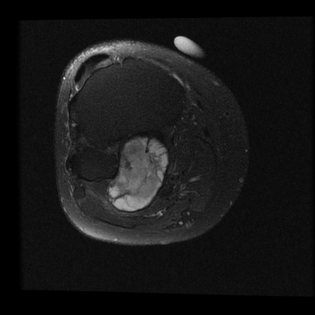 Intramuscular ganglion cyst - popliteus | Radiology Case | Radiopaedia.org