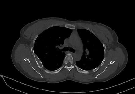 Fibrous dysplasia - rib | Radiology Case | Radiopaedia.org