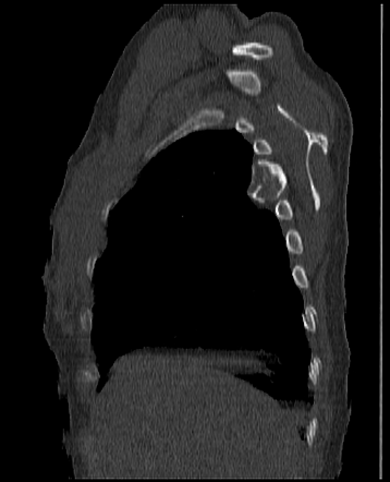 Fibrous dysplasia - rib | Image | Radiopaedia.org