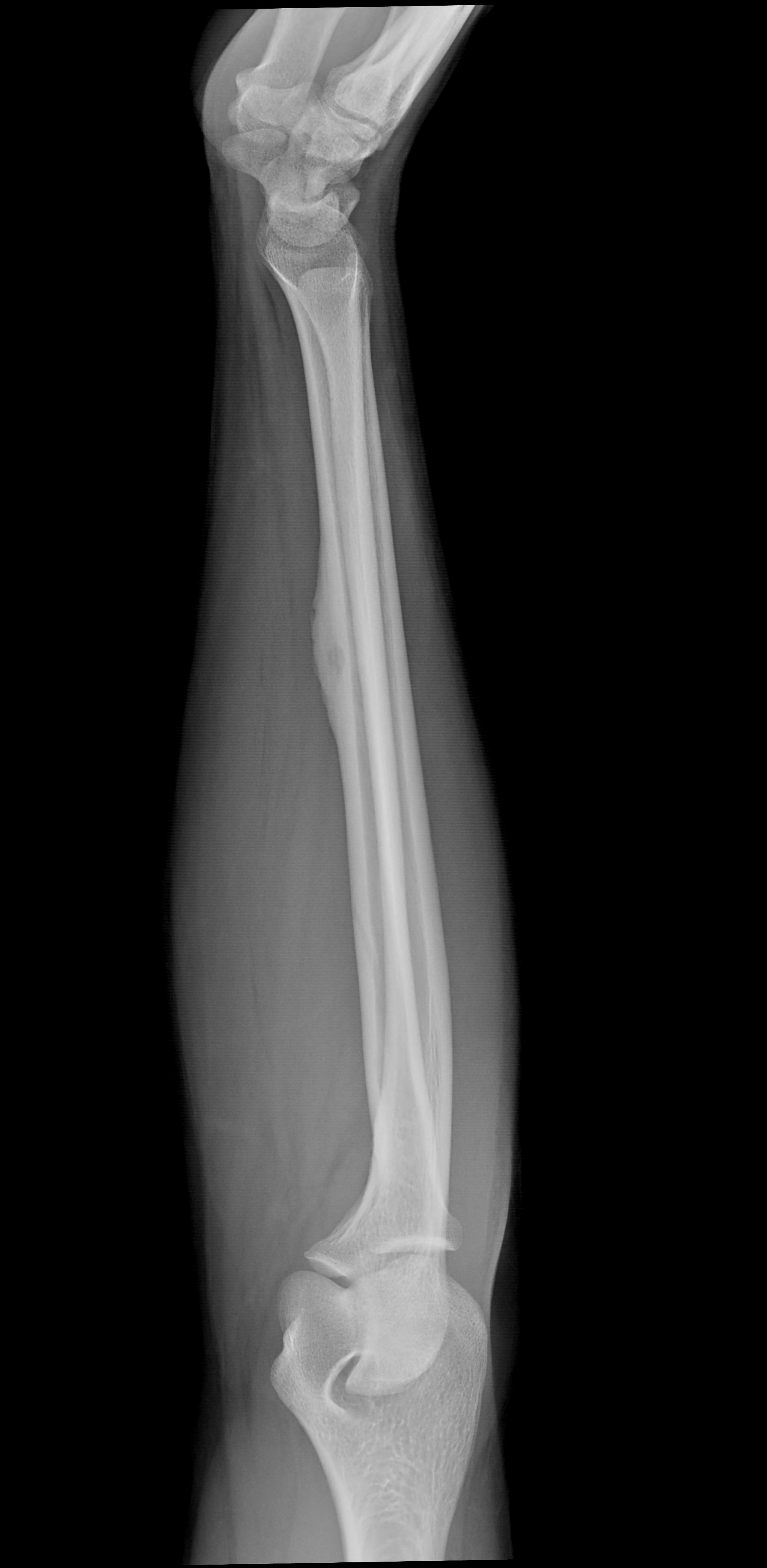 Osteoid Osteoma - Radius | Image | Radiopaedia.org