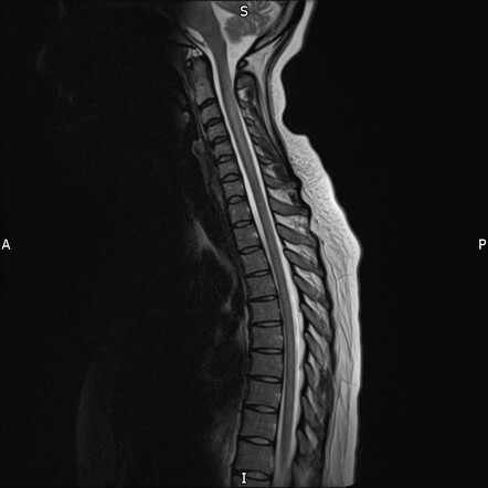 Subacute combined degeneration of cord | Radiology Case | Radiopaedia.org