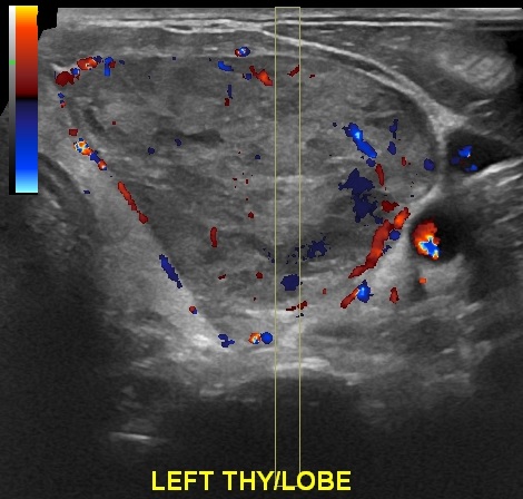 Hurthle cell thyroid cancer | Image | Radiopaedia.org