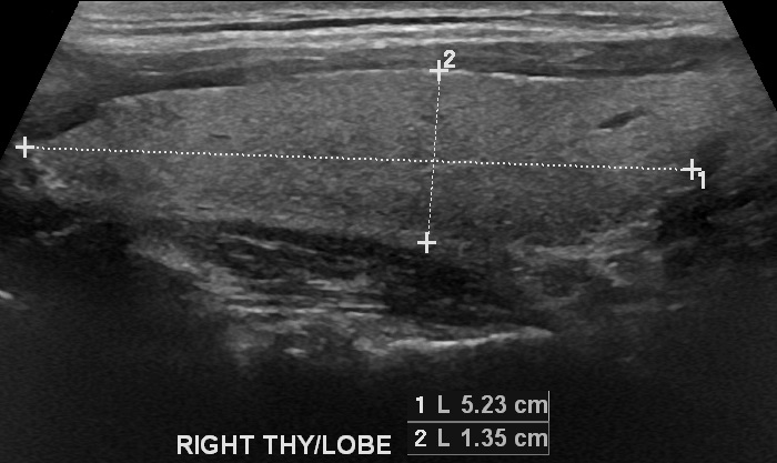 Hurthle cell thyroid cancer | Image | Radiopaedia.org