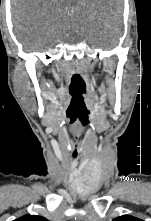 Hurthle cell thyroid cancer | Image | Radiopaedia.org